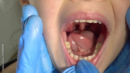 A doctor in blue gloves examines the child's mouth, the tooth is wobbling, followed by a new tooth.