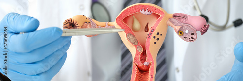 Man gynecologist showing female diseases with pen on plastic artificial model of uterus and ovaries closeup photo