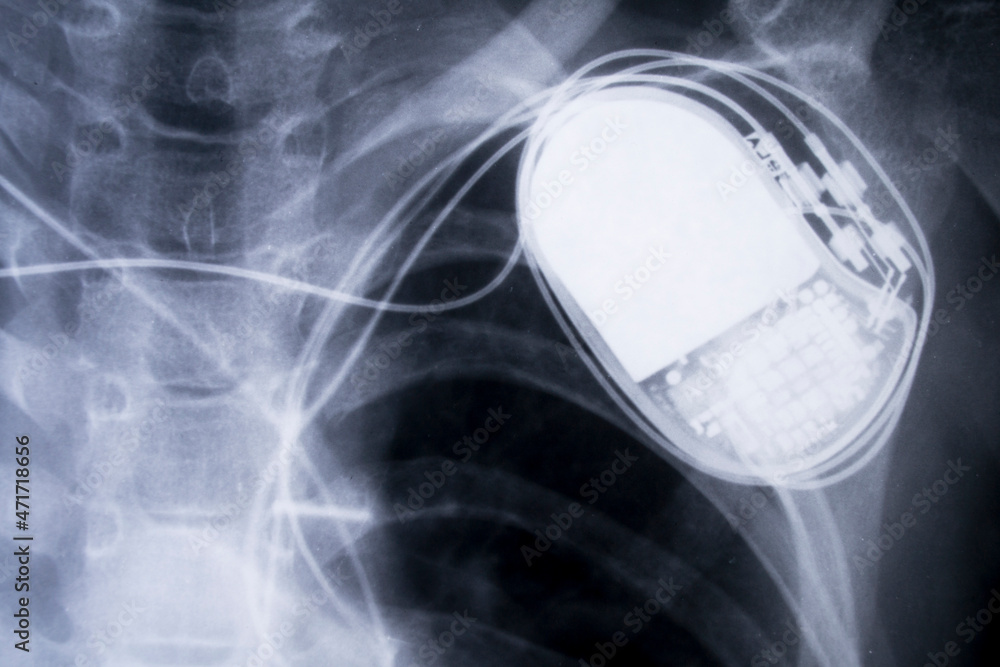 Fotografia x-ray imagefrom the human chest and pacemaker