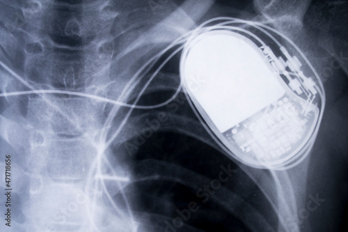 x-ray imagefrom the human chest and pacemaker photo