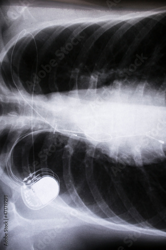 x-ray imagefrom the human chest and pacemaker photo