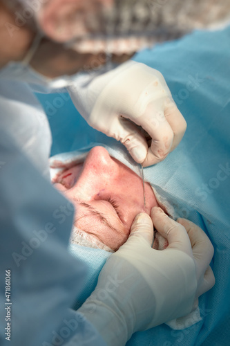 Close up of the face of a patient who is undergoing blepharoplasty. The surgeon cuts the eyelid and performs manipulations using medical instruments