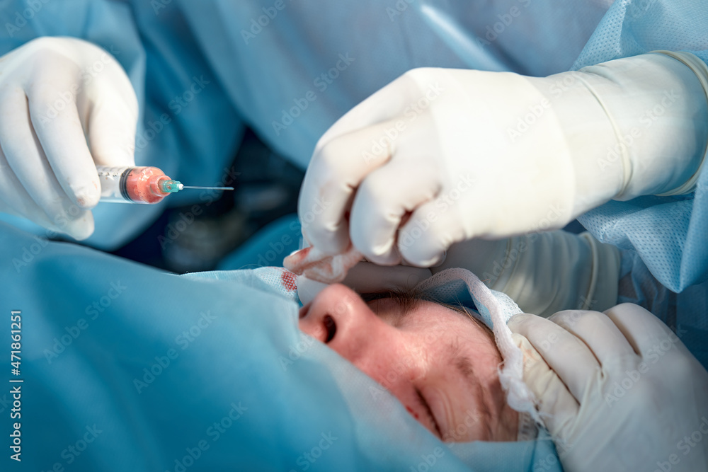 Close up of the face of a patient who is undergoing blepharoplasty. The surgeon cuts the eyelid and performs manipulations using medical instruments Close up of the face of a patient who is undergoing blepharoplasty. The surgeon cuts the eyelid and performs manipulations using medical instruments