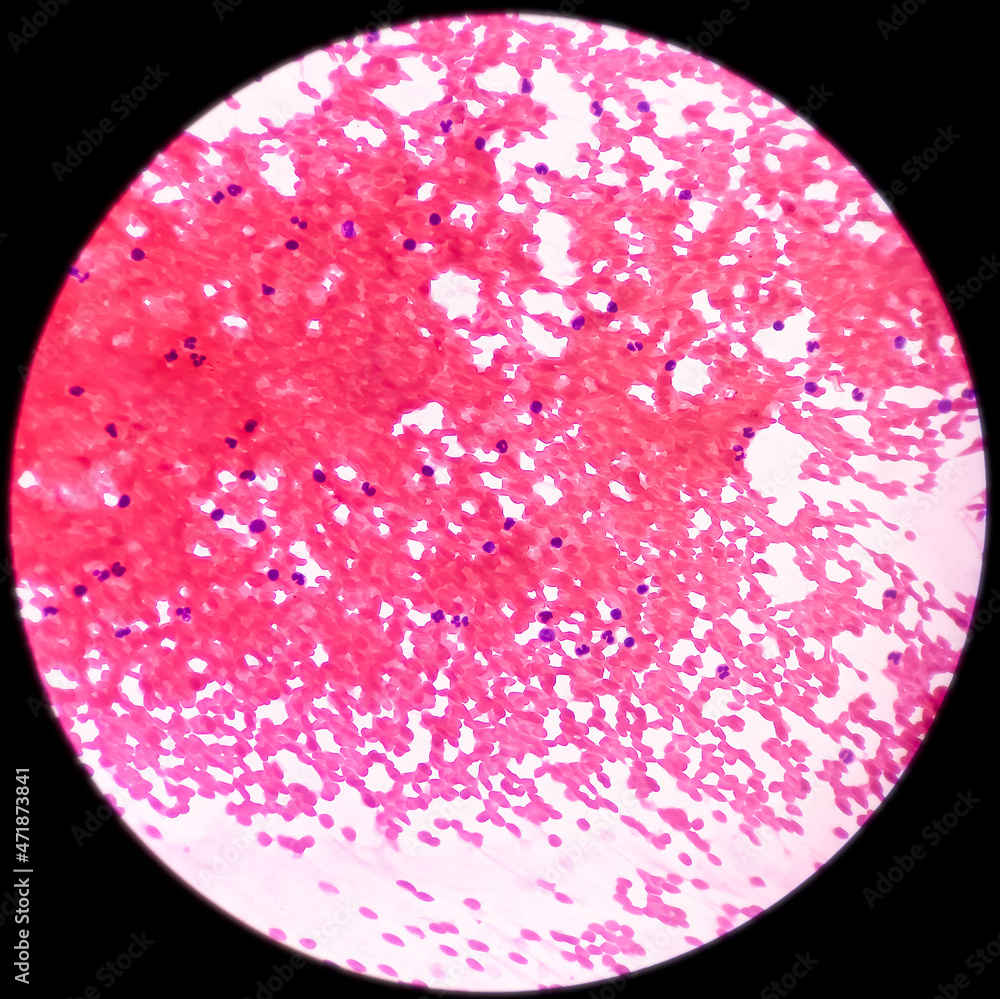 Fine needle aspiration (FNA) cytology of chronic sialadenitis of salivary gland, show cellular material composed of salivary acini, neutrophils and few lymphocytes. Fine needle aspiration (FNA) cytology of chronic sialadenitis of salivary gland, show cellular material composed of salivary acini, neutrophils and few lymphocytes.