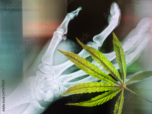 Cannabis leaf and bonescan as potential curation for arthritus