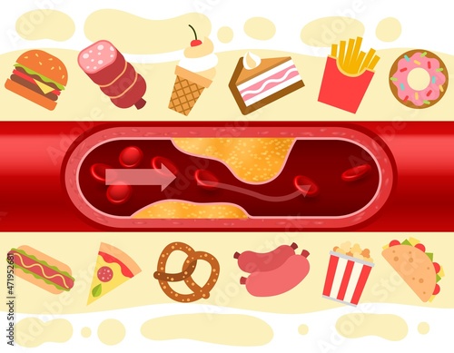 Consequences of fast food. Blood vessel with cholesterol plaque. Harmful nutrition. Atherosclerosis disease. Artery blockage. Cakes or hamburgers. Unhealthy donuts and pizza. Vector concept