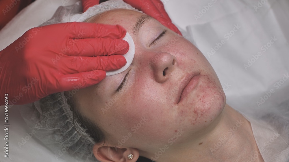 Wipe the mask off the face of a girl with problematic koja with cotton pads. Wipe the mask off the face of a girl with problematic koja with cotton pads.