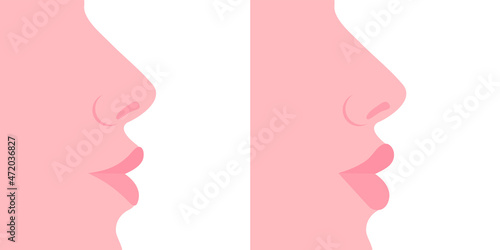 Female profile. Thin lips, plump lips. Plastic surgery, lip augmentation. Vector illustration, flat cartoon minimal design isolated on white background, eps 10.