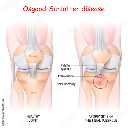Osgood–Schlatter disease. Healthy Joint and Apophysitis of the tibial tubercle photo