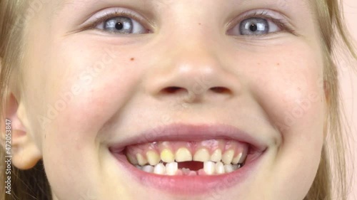 Close-up of the face of a little girl who shows her mouth with fallen milk teeth, grimaces.