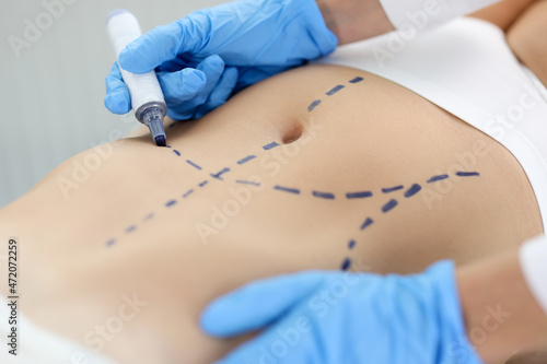 Obraz na płótnie Doctor drawing preoperative marking on patient abdomen closeup w salonie