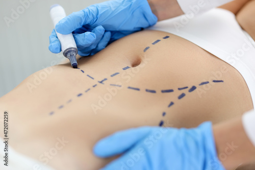 Doctor drawing preoperative marking on patient abdomen closeup photo