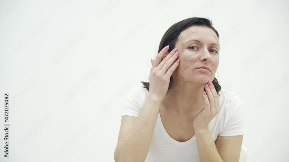 4k video of woman with acne problem squeezing pimple indoors. 4k video of woman with acne problem squeezing pimple indoors.