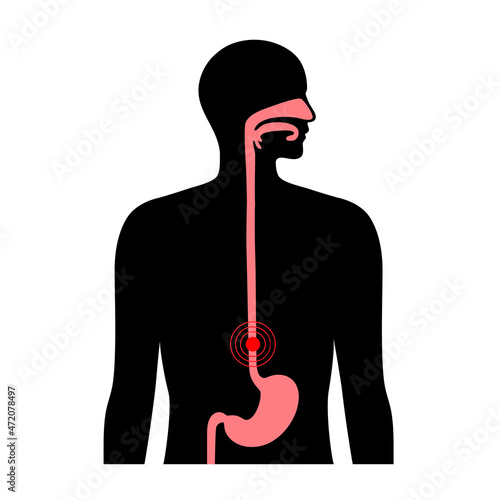 Gastroesophageal reflux disease