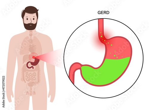 Gastroesophageal reflux disease