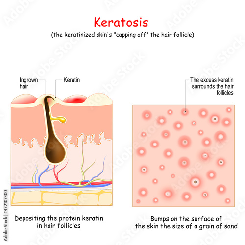Keratosis. Skin disease