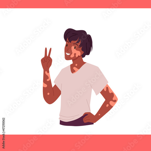 Man with vitiligo and skin depigmentation problem vector illustration. Cartoon portrait of funny guy showing victory gesture. Support for people with chronic skin disorder, vitiligo treatment concept
