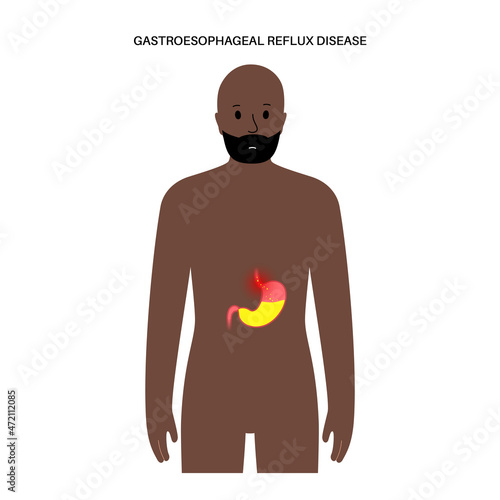 Gastroesophageal reflux disease