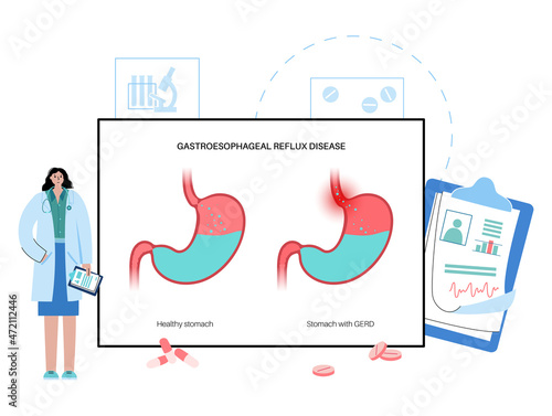 Gastroesophageal reflux disease