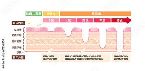 胃壁の断面図イラスト / 胃潰瘍の症状と重症度