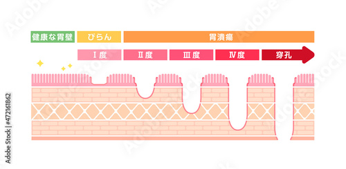 胃壁の断面図イラスト / 胃潰瘍の症状と重症度