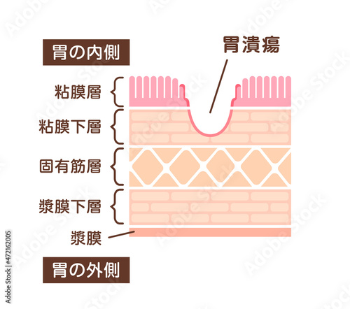 胃壁の断面図イラスト / 胃潰瘍の発生