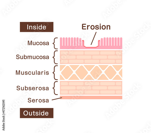 Sectional view illustration  of gastric erosion