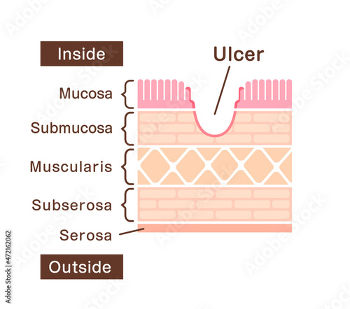 Sectional view illustration  of gastric ulcer