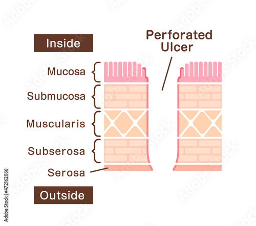 Sectional view illustration  of perforated ulcer