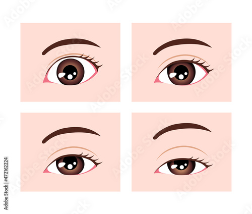 Grading in ptosis vector illustration