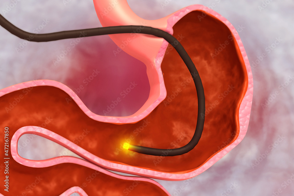 stomach Endoscopy.Gastric Balloon Inside a Stomach Stock Illustration