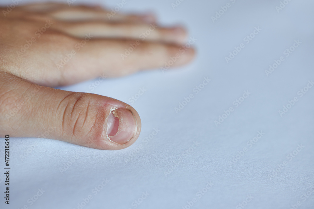 Changing the nail plate on the boy's thumb. Late symptom of