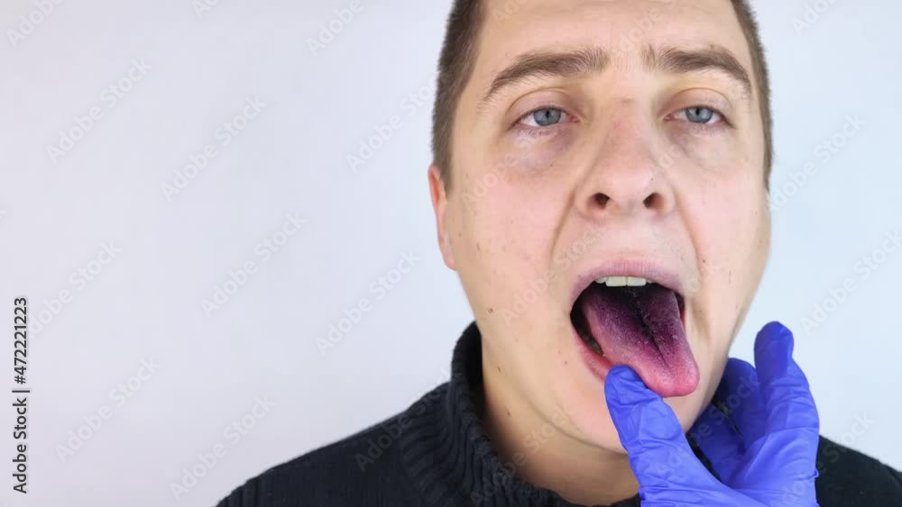 Closeup of a man black tongue. Clinical manifestations of lingua