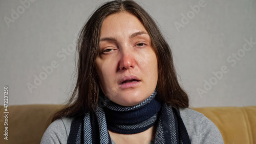 Sick depressed brunette woman wrapped in scarf with runny nose sneezes into napkin sitting under on sofa suffering from flu, closeup