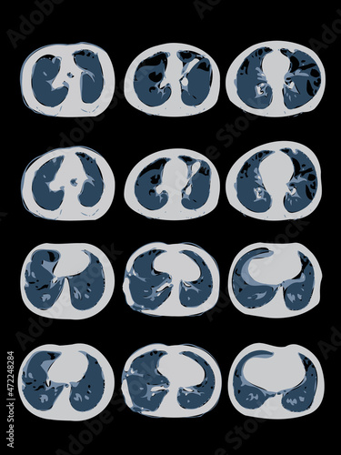 Covid-19 Computed Tomography Of The Lungs. CT Scan
