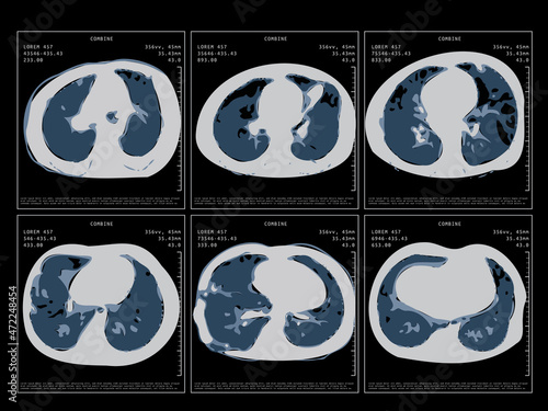 Covid-19 Computed Tomography Of The Lungs. CT Scan