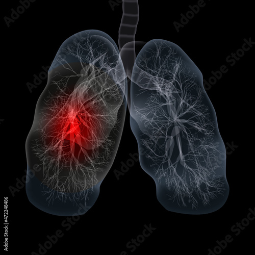 Covid-19 Computed Tomography Of The Lungs. CT Scan