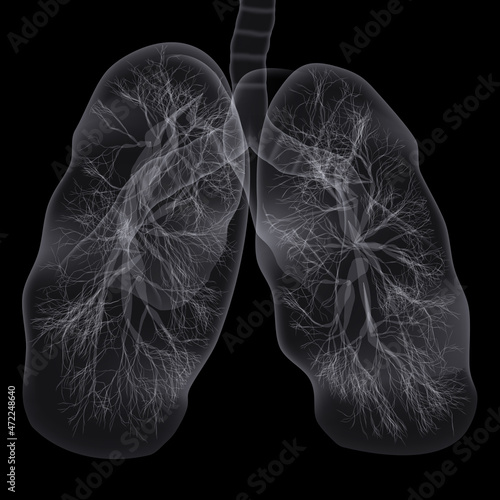 Covid-19 Computed Tomography Of The Lungs. CT Scan