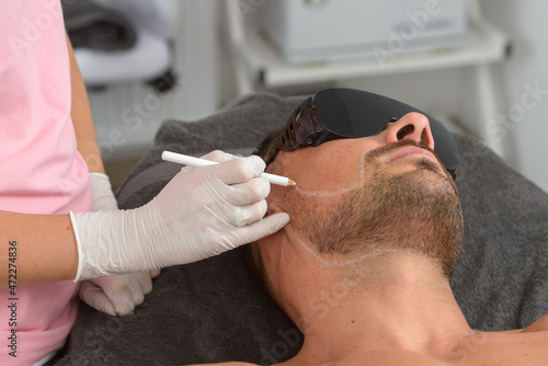 Laser hair removal on mans face. man in a goggles. photo
