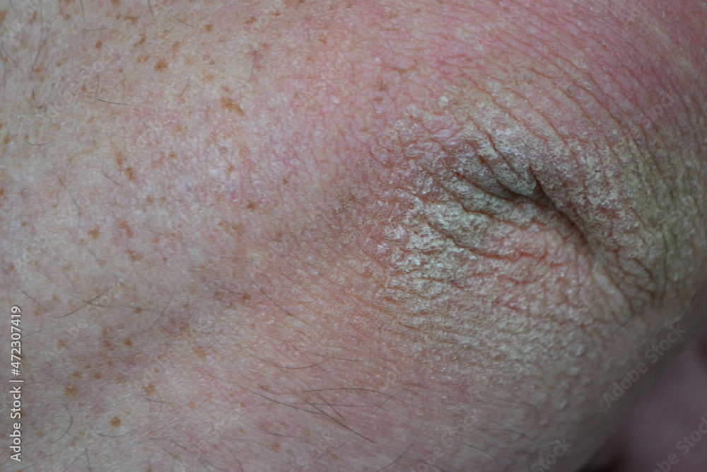 Close up dry flaky skin on elbow, caused by psoriasis. High quality photo Close up dry flaky skin on elbow, caused by psoriasis. High quality photo