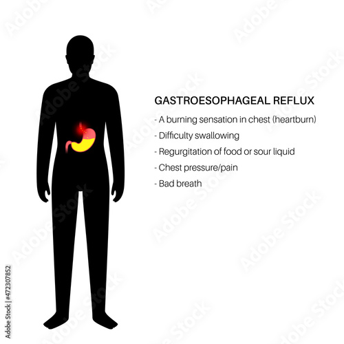 Gastroesophageal reflux disease