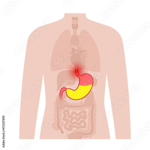 Gastroesophageal reflux disease