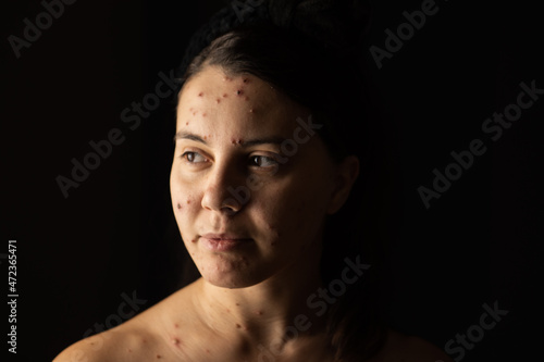 Fotografie adult woman portrait chickenpox disease