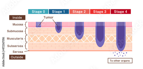 Stages of stomach cancer (gastric cancer) . Vector illustration