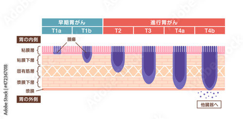 Stages of stomach cancer (gastric cancer) . Vector illustration