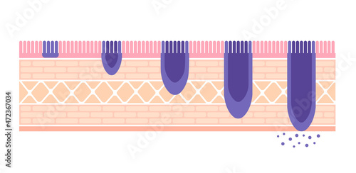 Stages of stomach cancer (gastric cancer) . Vector illustration