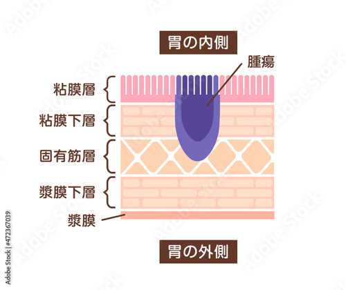 Sectional view illustration of stomach cancer (gastric cancer)