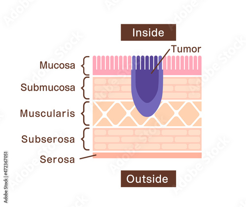 Sectional view illustration of stomach cancer (gastric cancer)