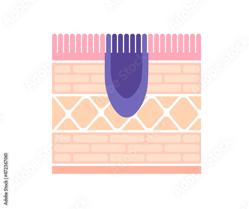 Sectional view illustration of stomach cancer (gastric cancer)
