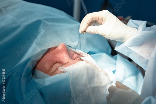 Close up of the face of a patient who is undergoing blepharoplasty. The surgeon cuts the eyelid and performs manipulations using medical instruments